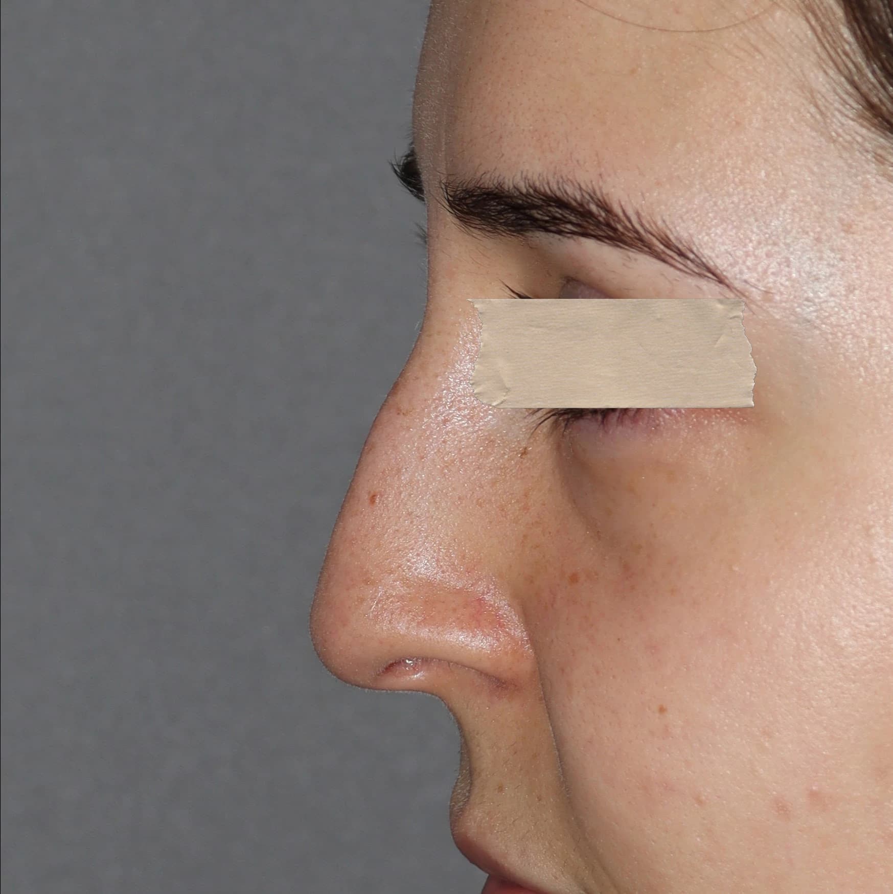 Rinomodelação - Antes