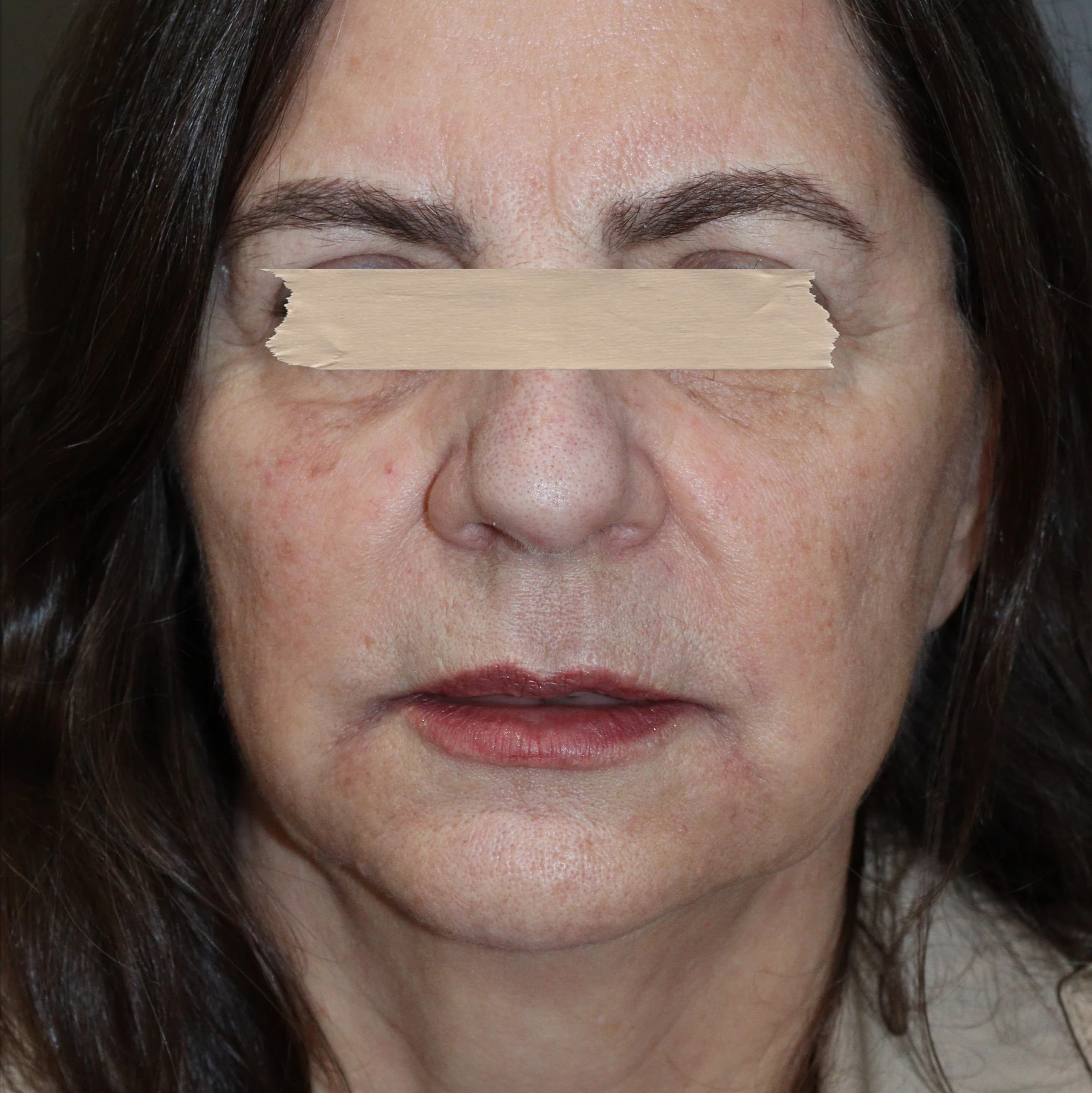 Tratamento Antiaging - Depois