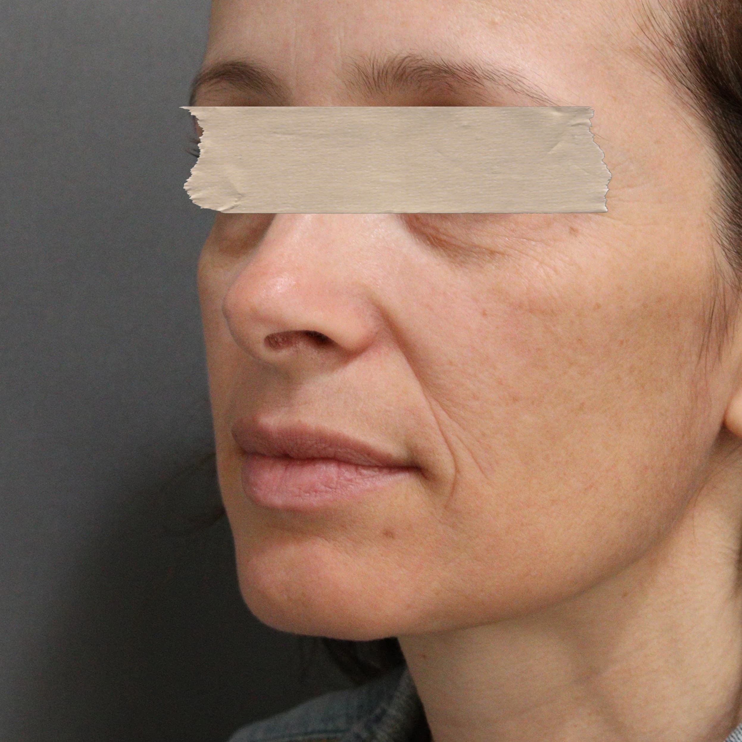 Tratamento Antiaging - Antes