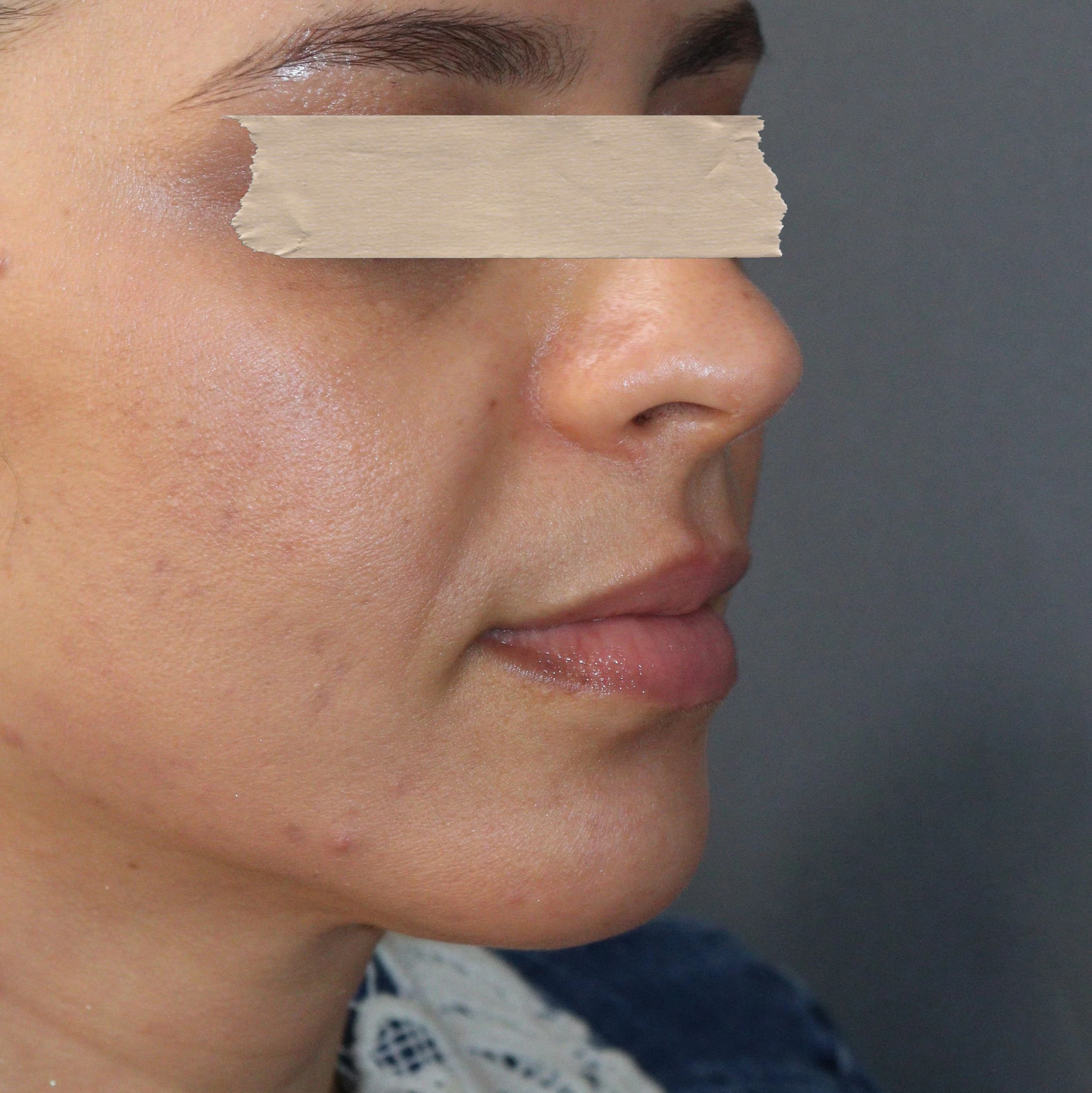 Tratamento Antiaging - Antes