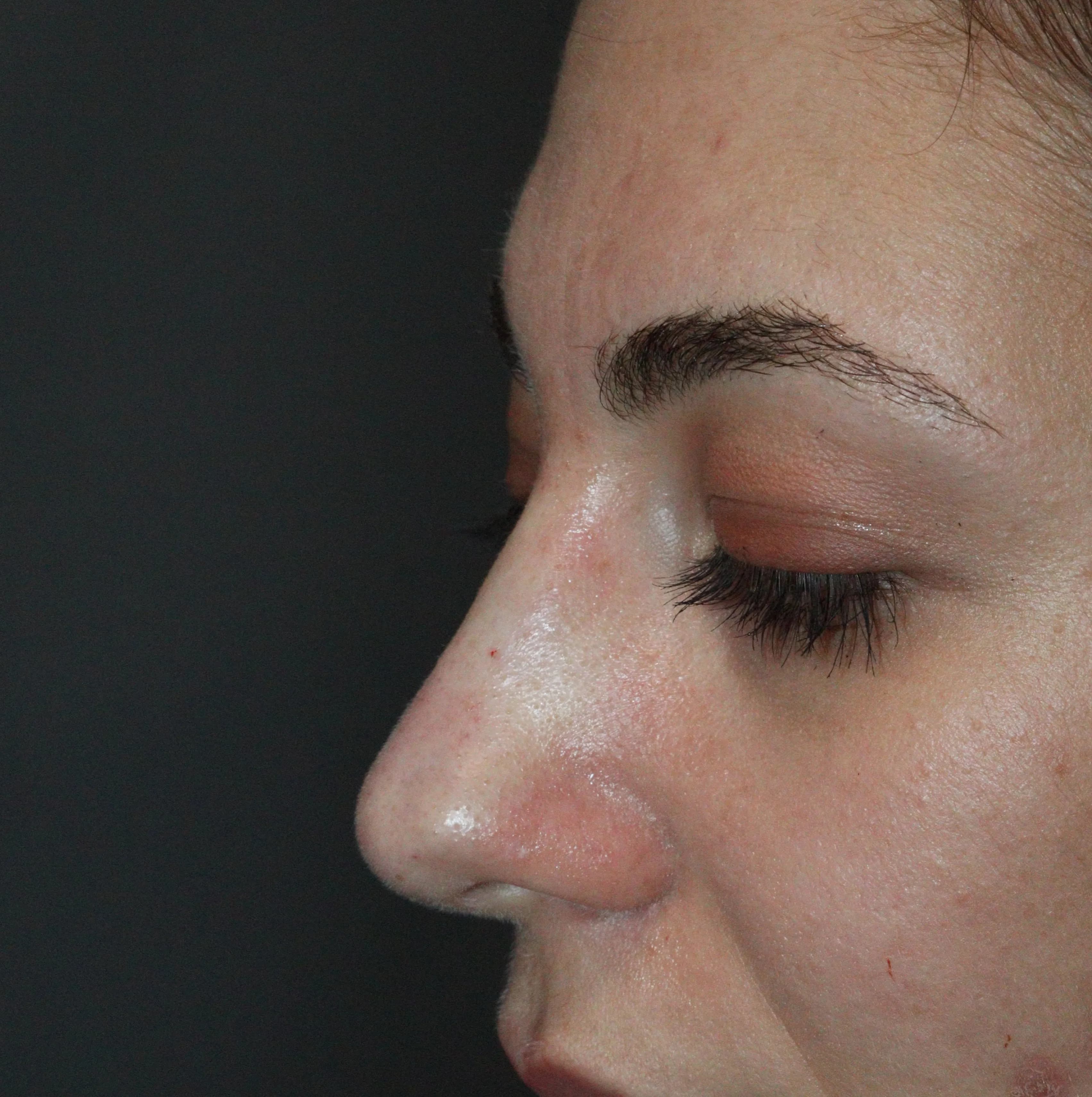 Rinomodelação - Depois