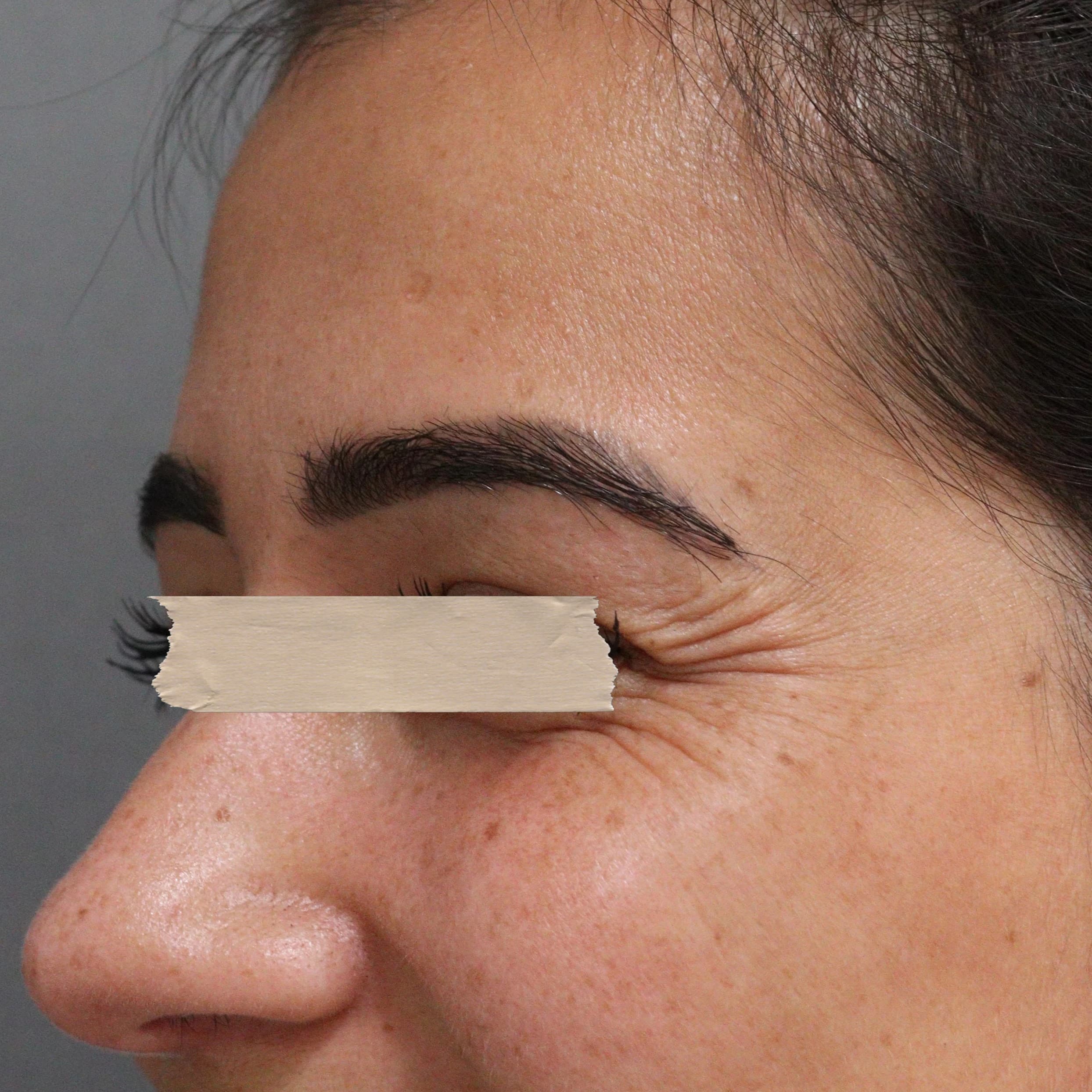 Toxina Botulínica - Antes