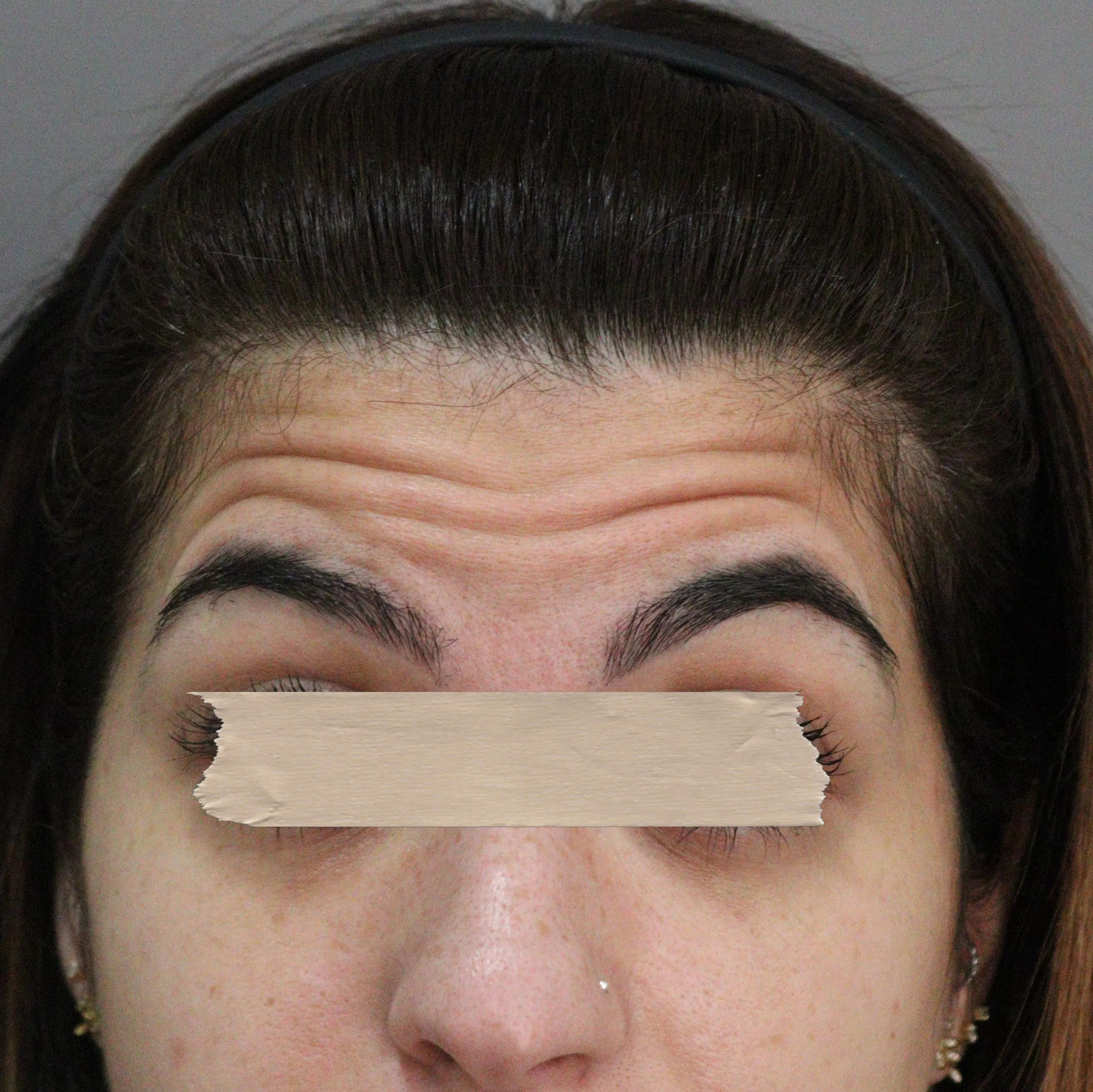 Toxina Botulínica - Antes