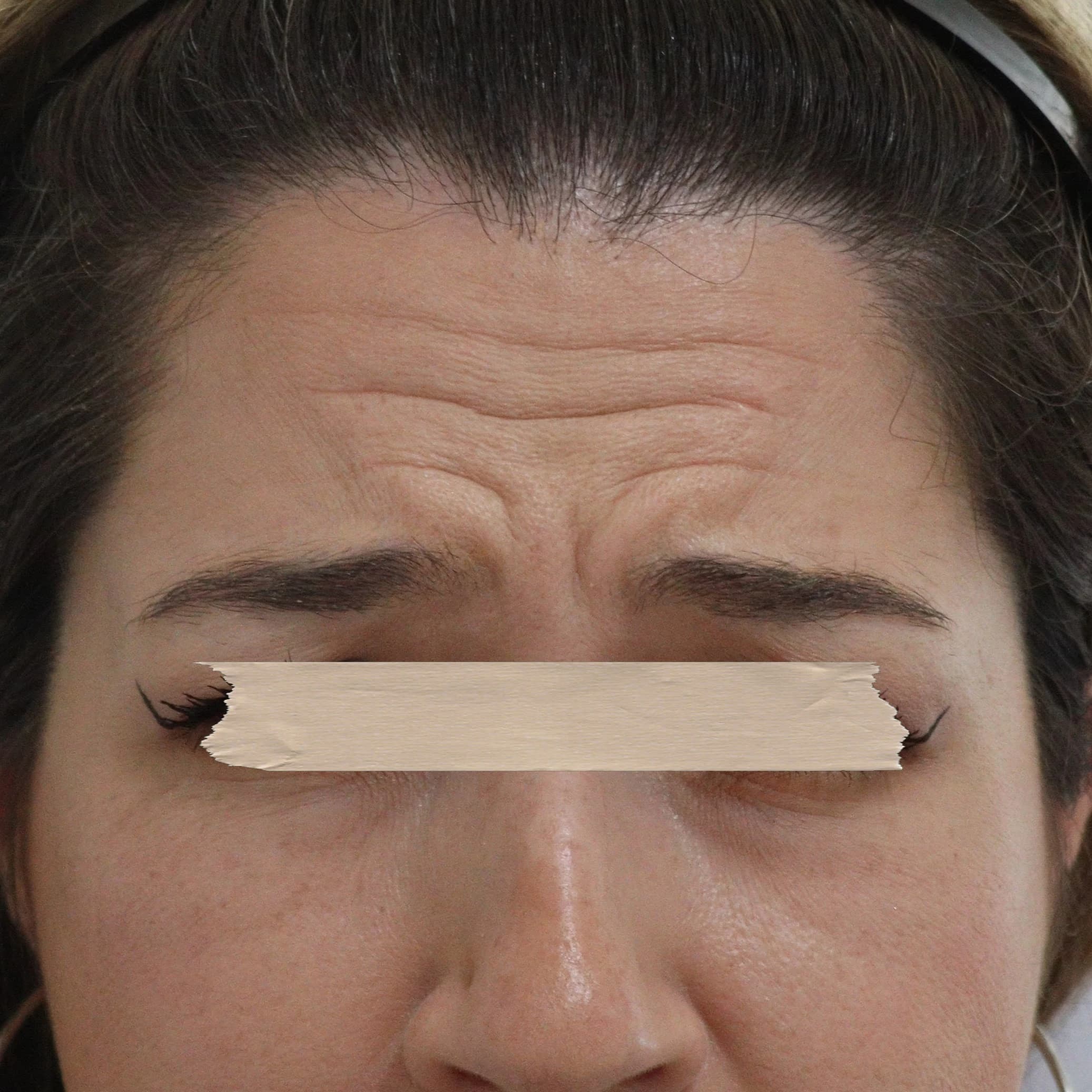 Toxina Botulínica - Antes