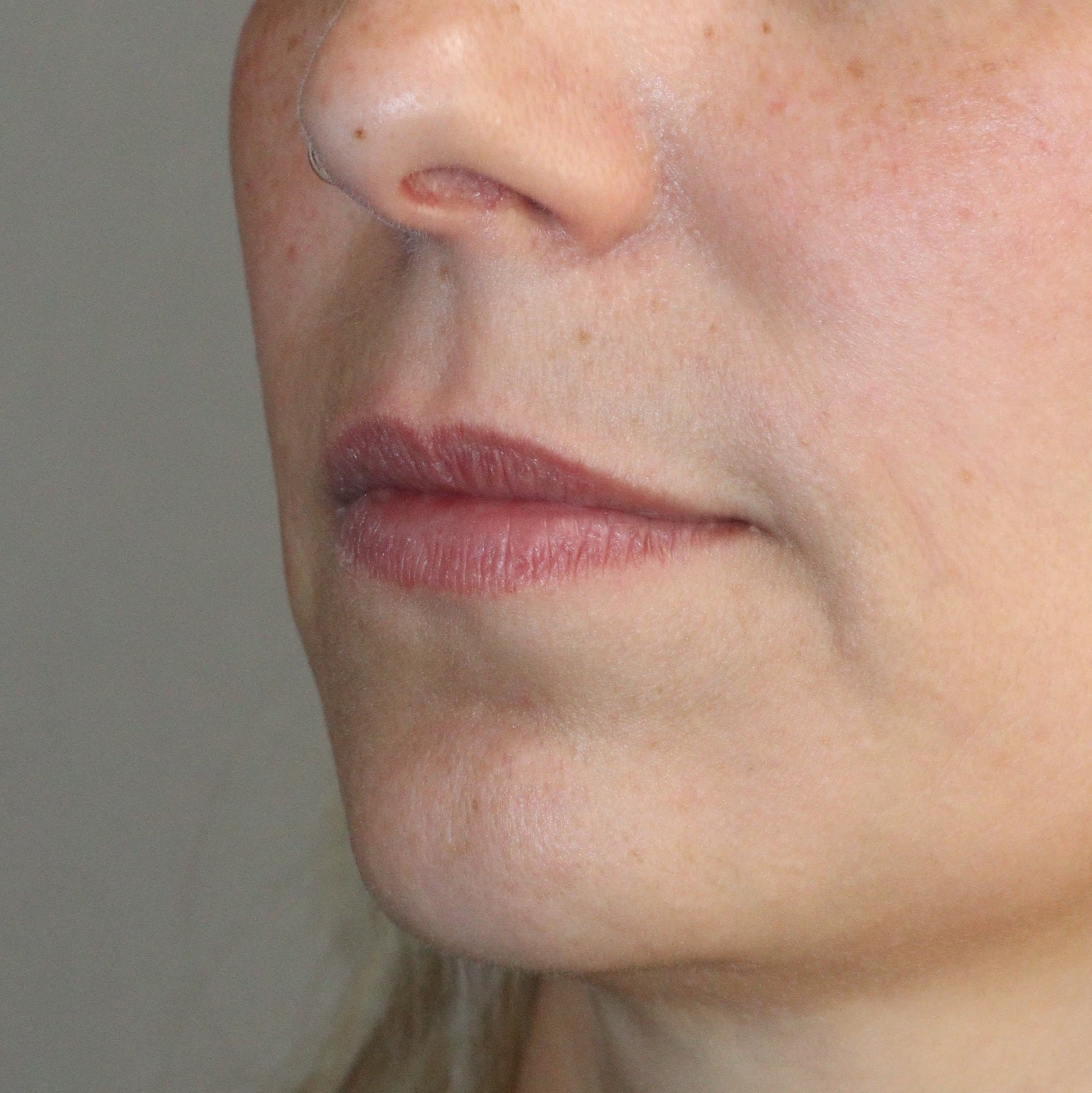 Preenchimento Labial - Antes