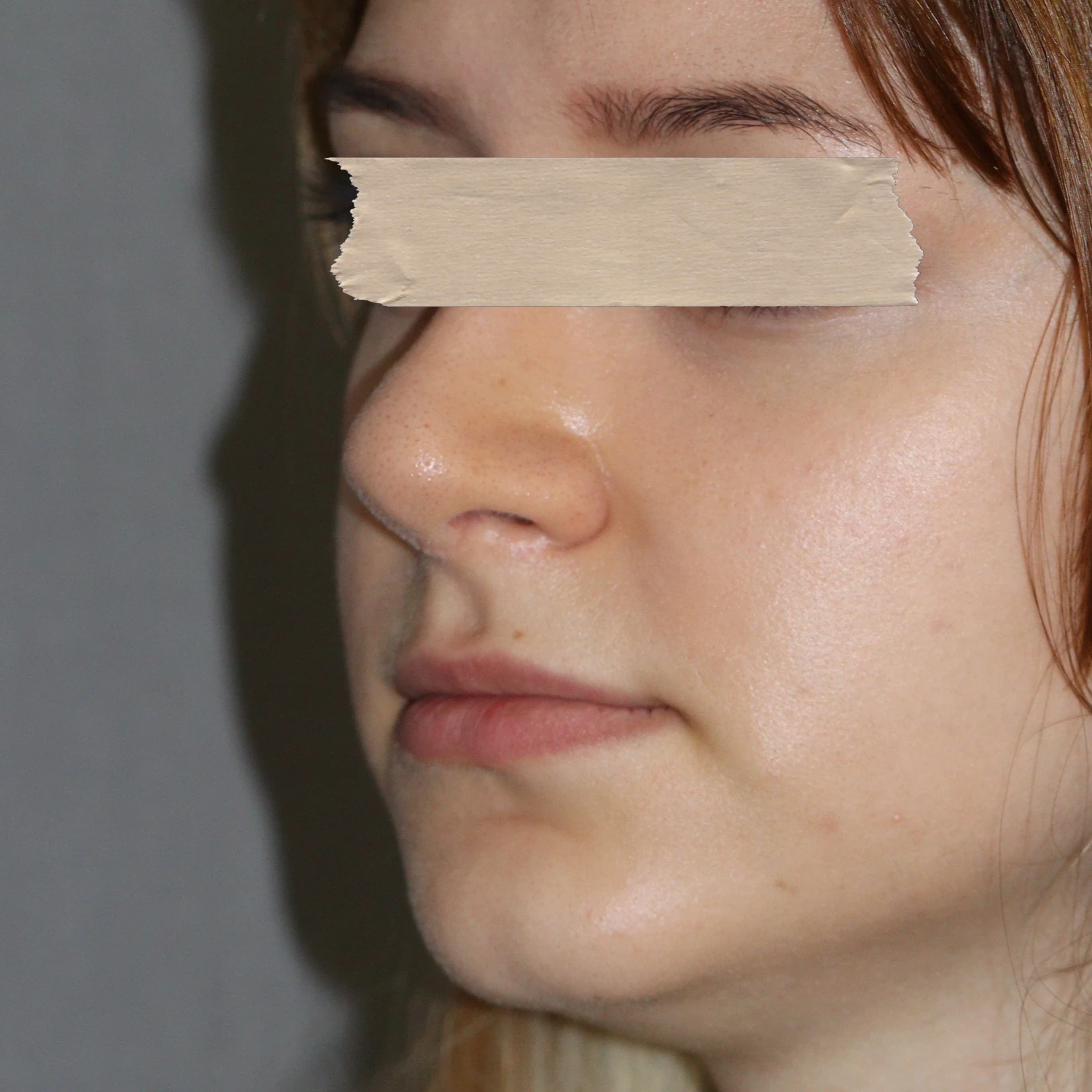 Preenchimento Labial - Antes