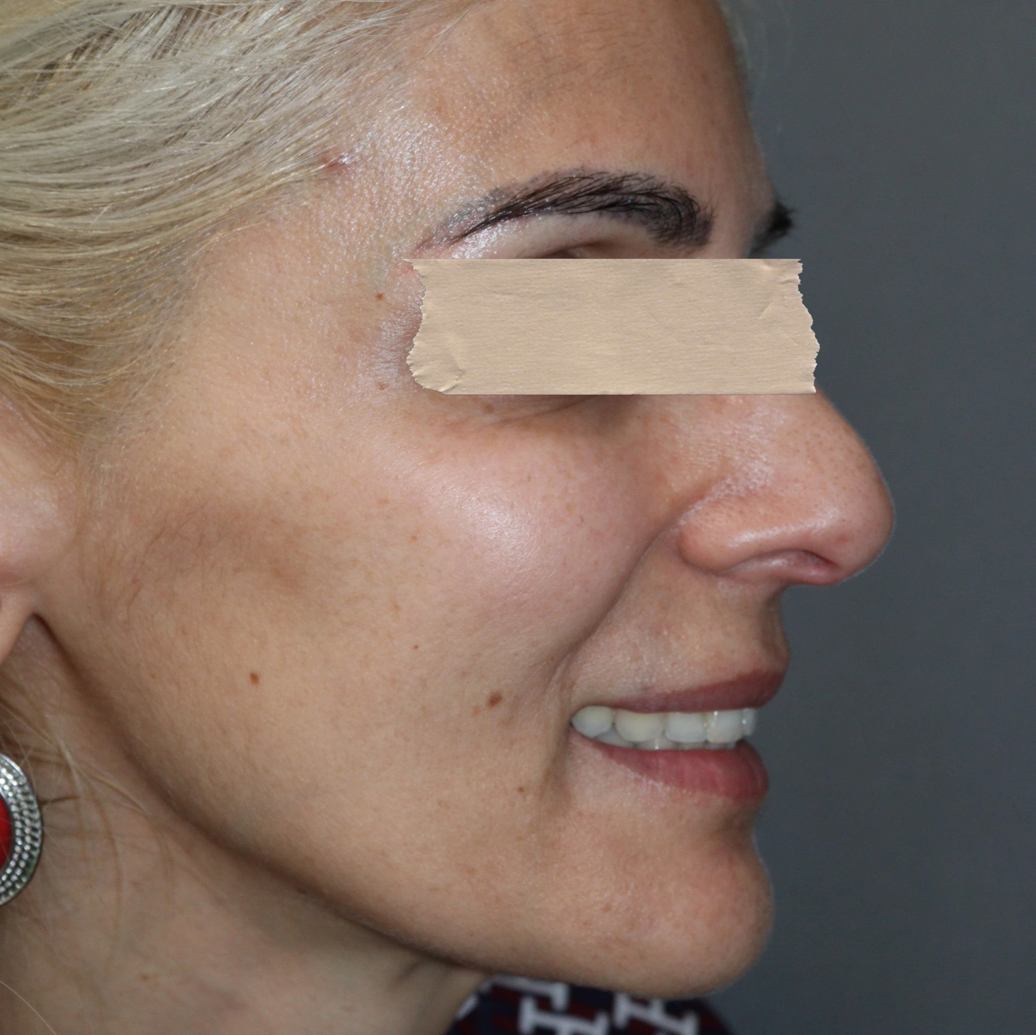 Bioestimuladores de Colagénio - Depois