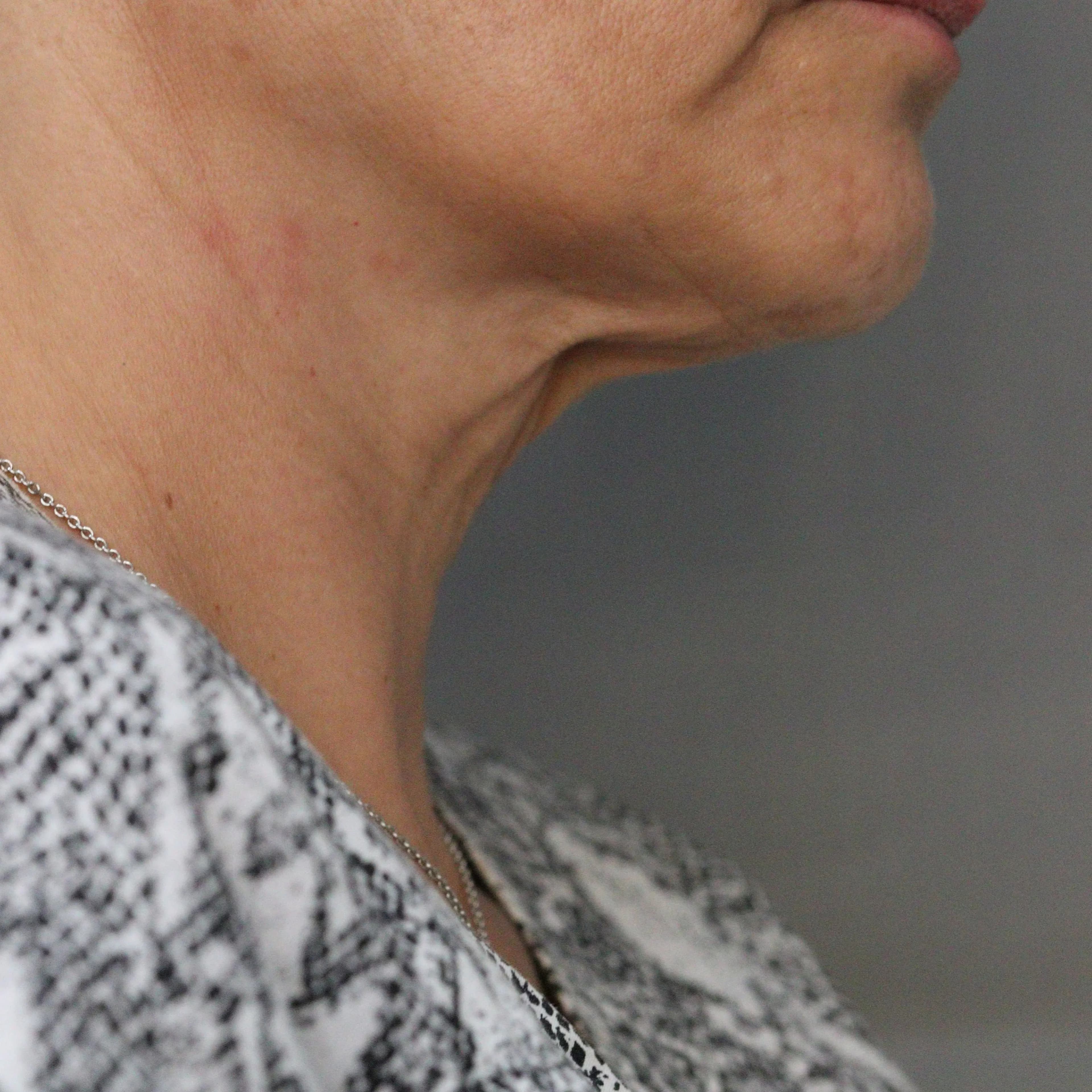 Bioestimuladores de Colagénio - Depois