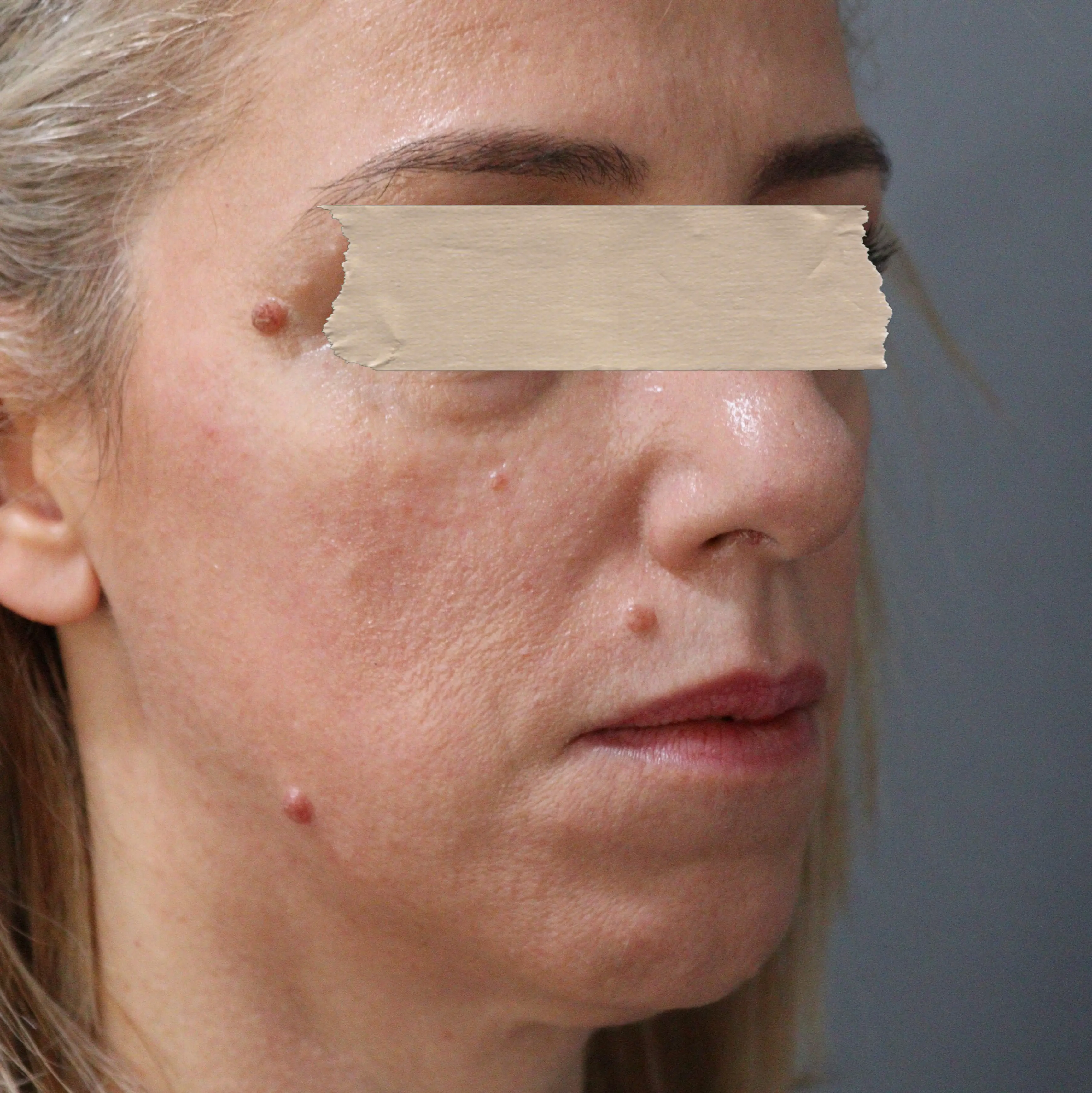 Bioestimuladores de Colagénio - Antes