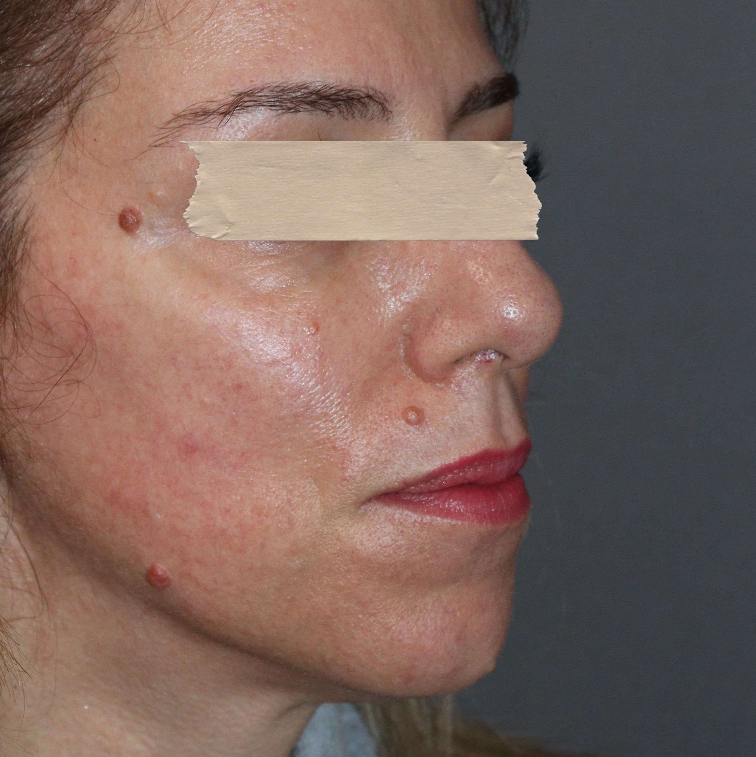 Bioestimuladores de Colagénio - Depois